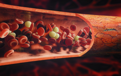 Terapia de Quelaci�n o Barrido Arterial
