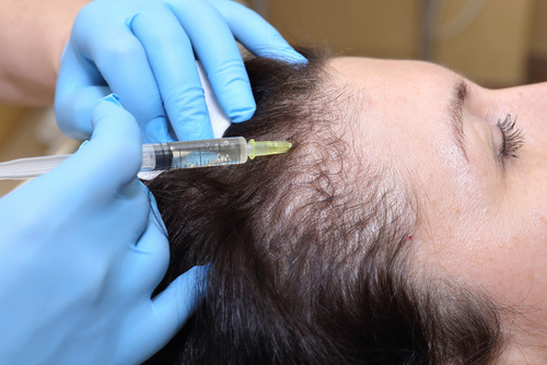 Tratamiento Alopecia y Ca�da del Cabello